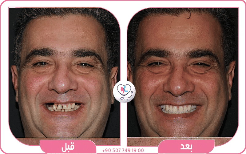 جربتي مع زراعة الأسنان الفورية