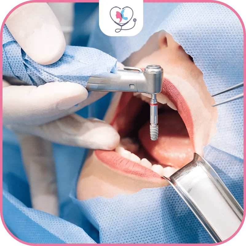 Différences entre les mini implants et les implants traditionnels 