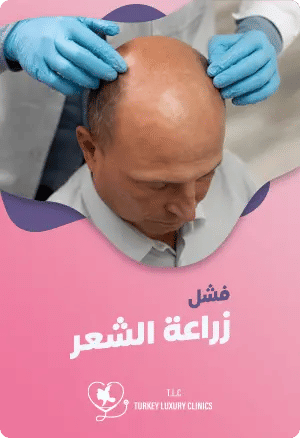 علامات فشل زراعة الشعر: أسباب الفشل وكيفية تجنبهاfeatured image