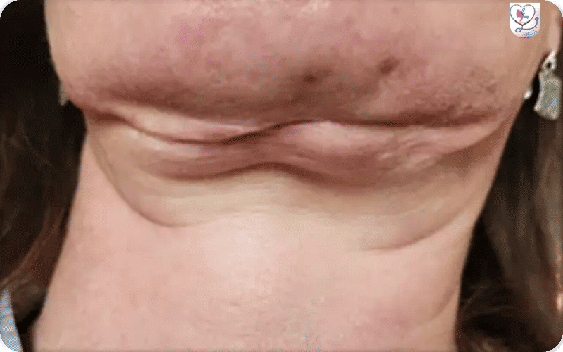 Bad Neck Lift Photos
