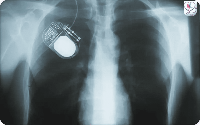 4. Pulse‑Generator Implantation 3