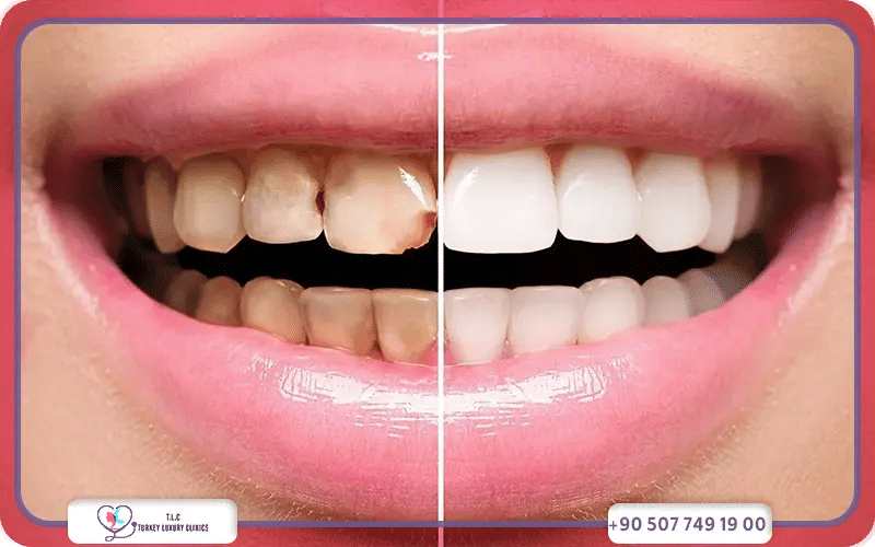 تجميل الأسنان الأمامية