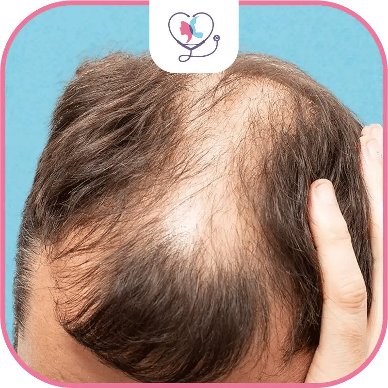 alopécie androgénétique homme