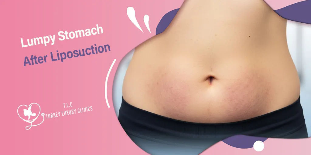 Bauchfalten nach Liposuktion: Ursachen und Lösungen