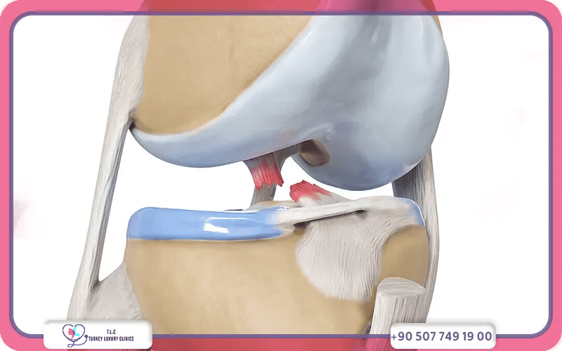 طرق تقليل تكلفة عملية الرباط الصليبي