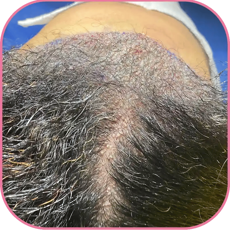 Hair Transplant for Women with Thinning Hair deacribr