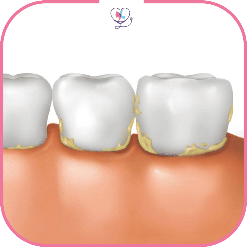 Causes de la parodontite