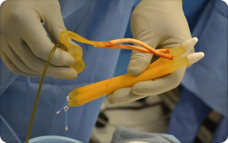 What is Penis Enlargement Surgery?