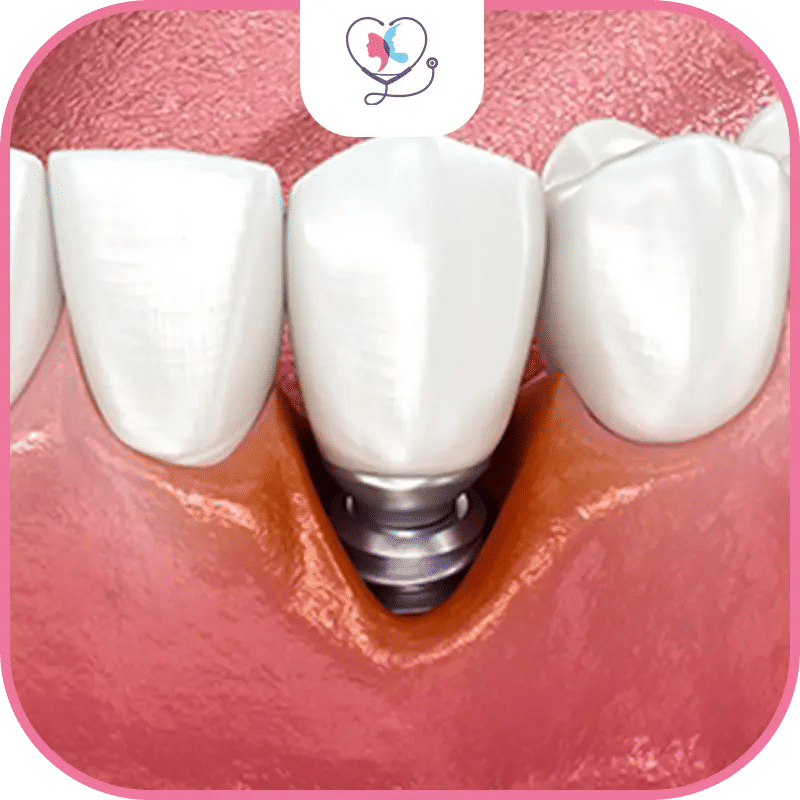 علامات فشل زراعة الأسنان