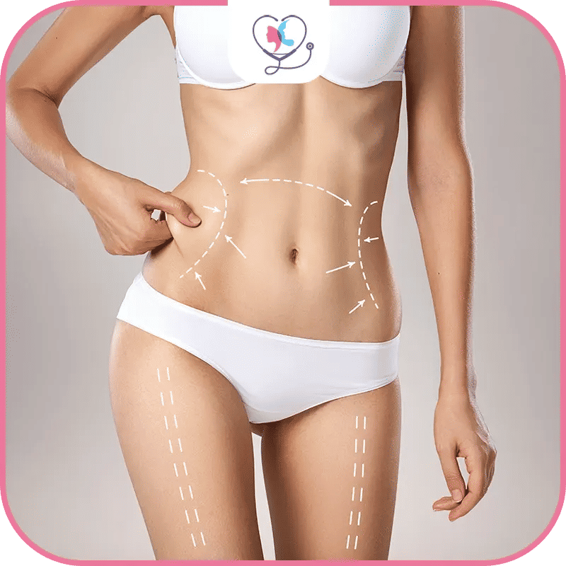 liposuccion abdominale - liposuccion ventre-différence entre abdominoplastie et liposuccion