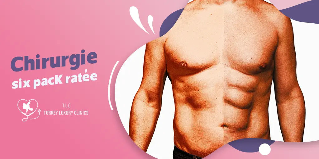 Chirurgie six pack ratée : Causes, symptômes et solutions