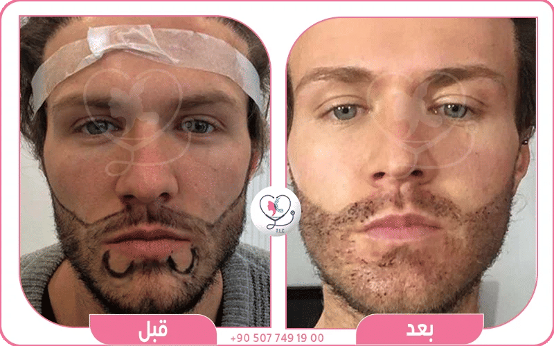 نتائج زراعة شنب قبل وبعد