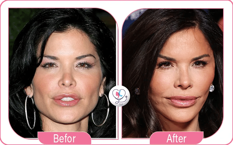 How Much Plastic Surgery Did Lauren Sánchez Have?