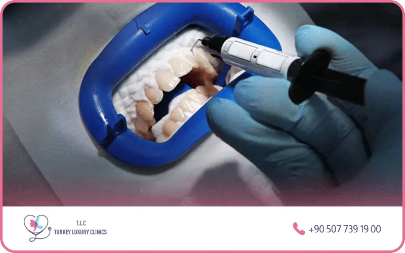 Professional teeth whitening procedure Turkey – cosmetic dental treatment at affordable prices in Istanbul