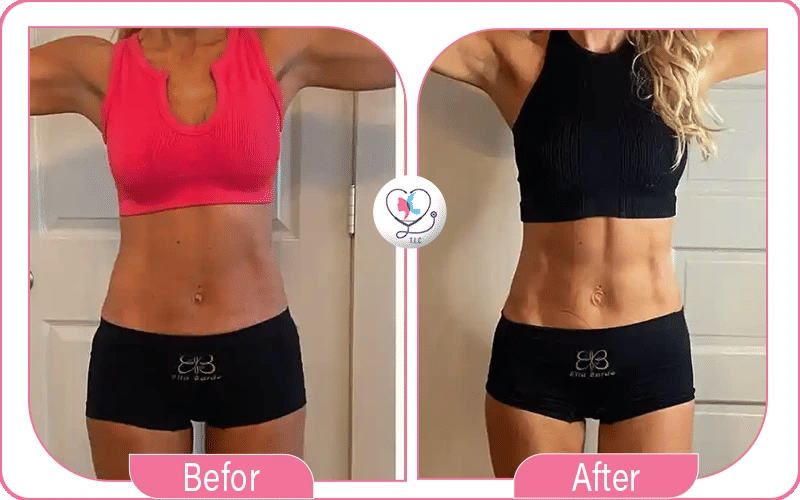 تجربتي مع عملية نحت الجسم