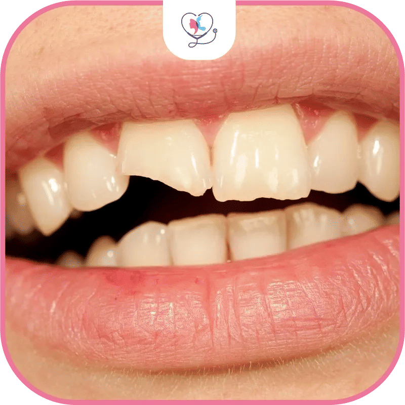 أنواع تركيبات الأسنان