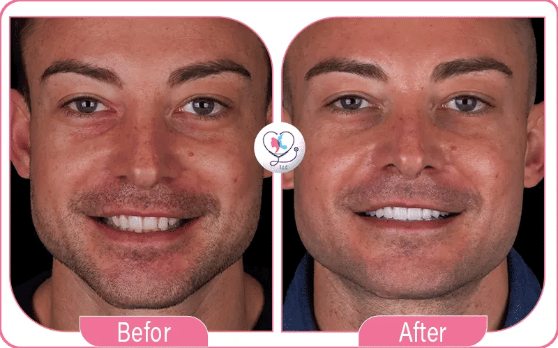 تجربتي مع تبييض الأسنان بالليزر للأسنان الحساسة