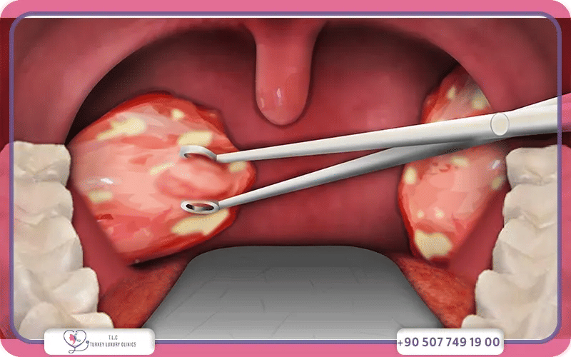Tonsillectomy Cost in the United States