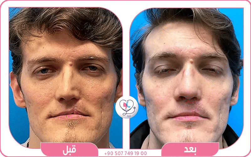 الشفة الارنبية عند الكبار