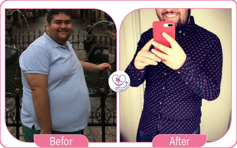 الاكتئاب بعد التكميم-1772048967146