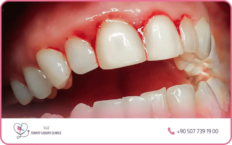 أعراض جير الأسنان