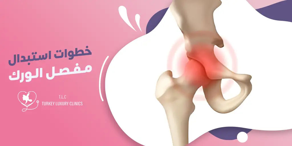 خطوات استبدال مفصل الورك: من التشخيص إلى العلاج والتعافي