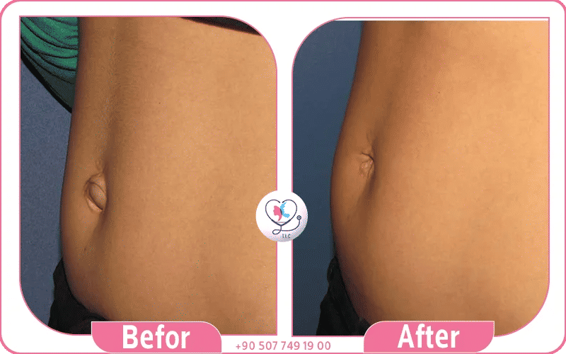 المرشحون لعملية تجميل السرة المرشحون لعملية تجميل السرة