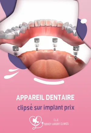 Appareil dentaire clipsé sur implant prix : France vs Turquie, facteurs, et témoignages