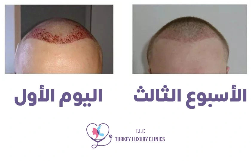 الفترة الفورية بعد العملية (0-7 أيام) 