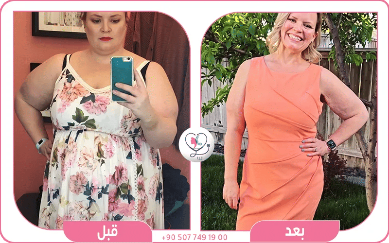 عملية تحويل مسار المعدة لدى تركيا لاكشري كلينك