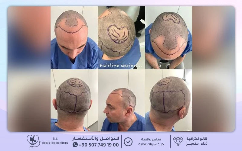 المعاينة ورسم الخط