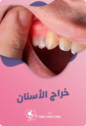 خراج الاسنان: الأعراض، الأسباب، وطرق العلاج الفوري لتجنب المضاعفاتfeatured image