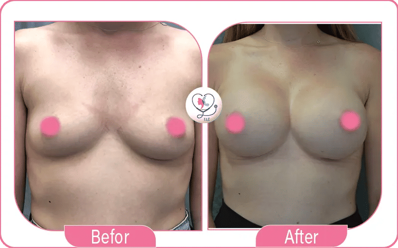 تجربتي مع شد الثدي الليزر