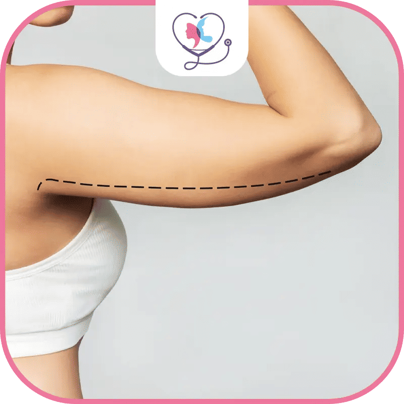 liposuccion des bras - liposuccion bras avant après