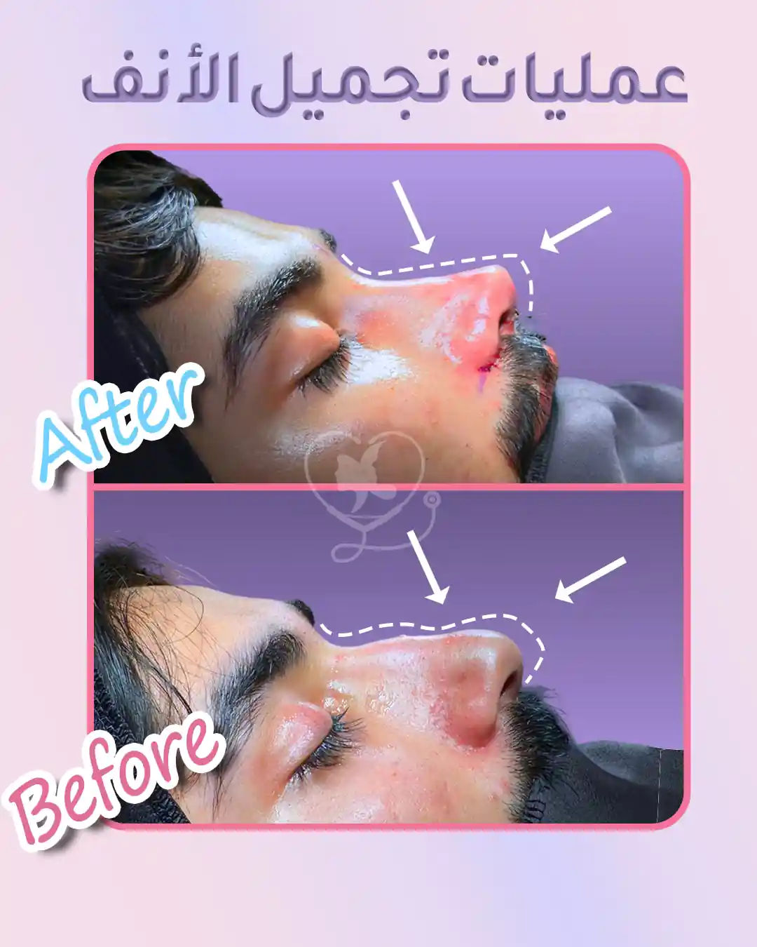 10 نصائح لضمان نجاح عملية تجميل الأنف