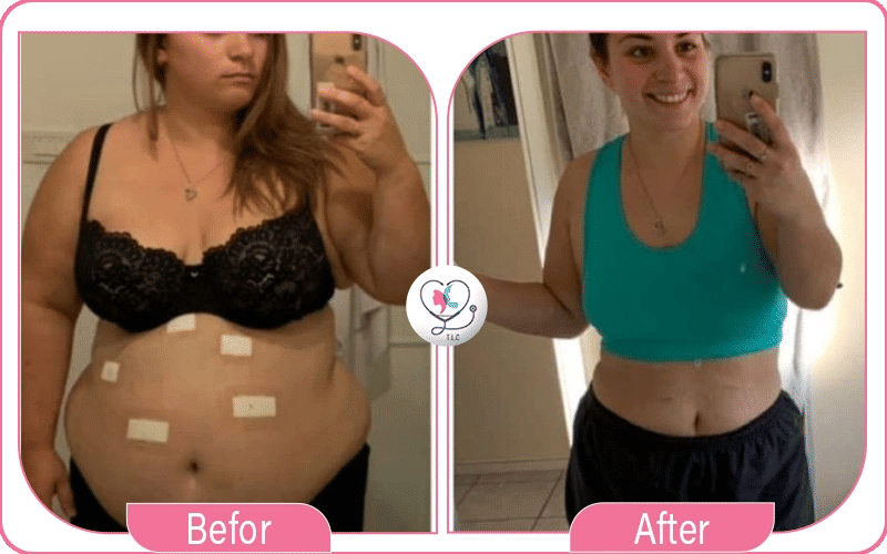 High BMI Lipo 360 Before and After Pictures 2