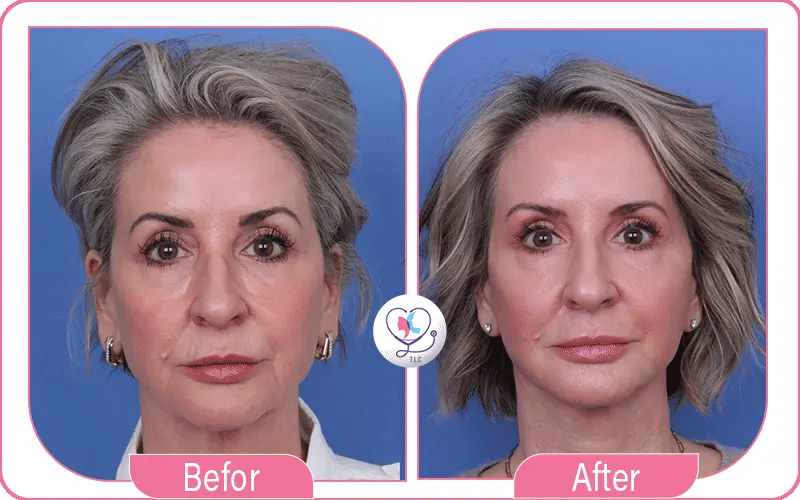 Blépharoplastie médicale avant après