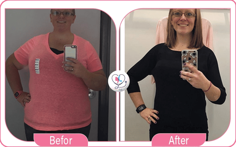 التعافي بعد تجربتي مع عملية تكميم المعدة