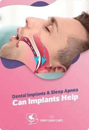 Zahnimplantate & Schlafapnoe: Können Implantate helfen?