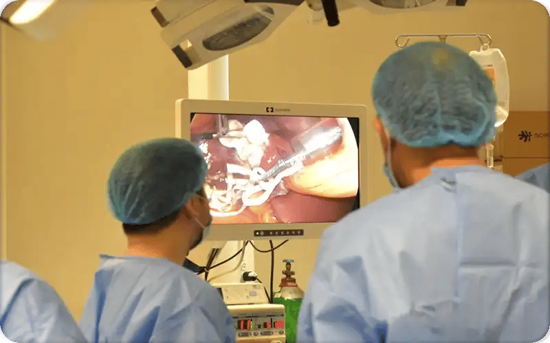 Endo-sleeve avant / après