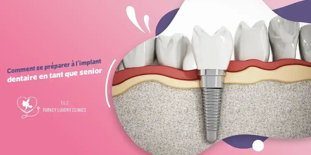 Comment se préparer à l'implant dentaire en tant que senior
