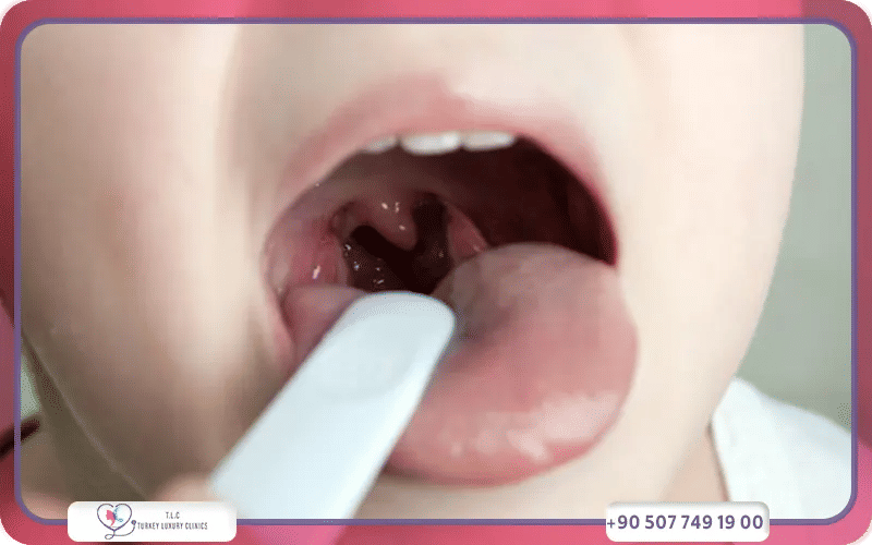 What to Expect During the Tonsillectomy and Adenoidectomy Procedure