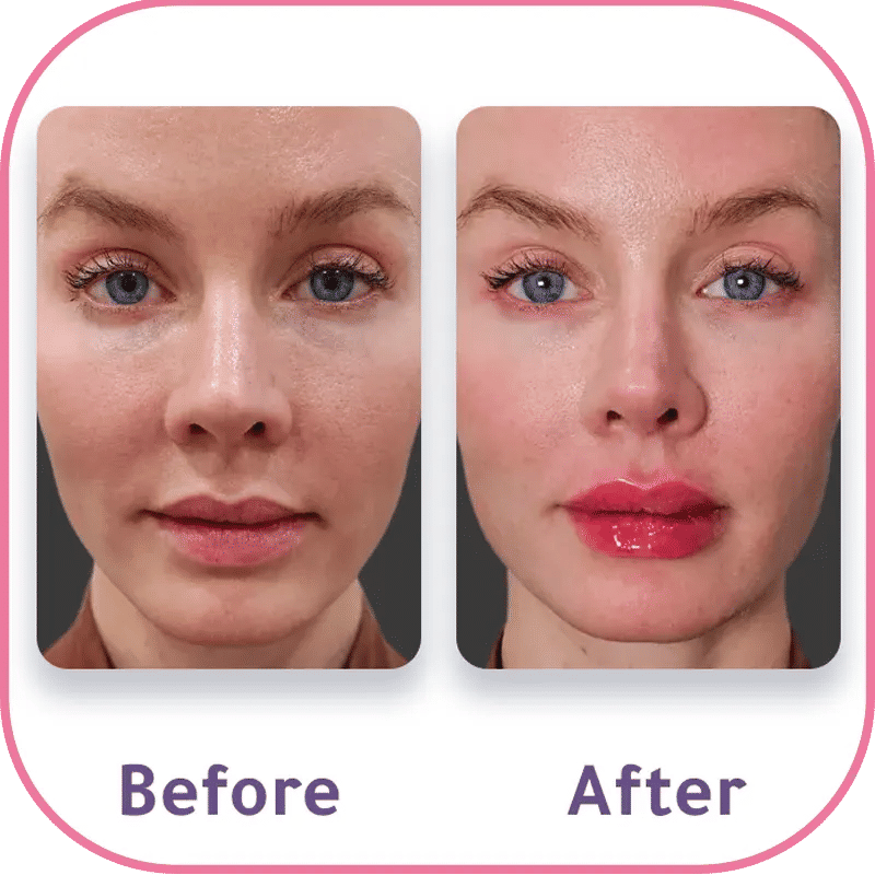 cost for addressing vertical lines around the lips