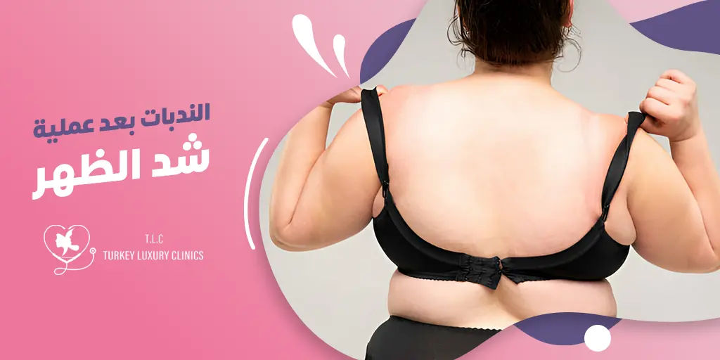 الندبات بعد عملية شد الظهر: كل ما يهمك