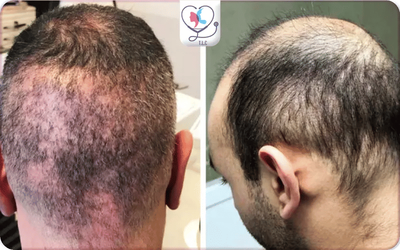 Signs of Hair Transplant Gone Wrong