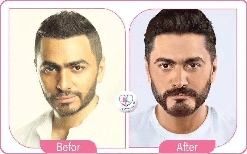 هل أجرى تامر حسني عملية تجميل في الفك؟