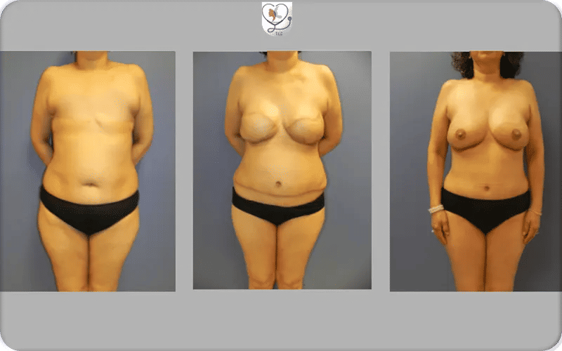 Reconstruction mammaire après cancer