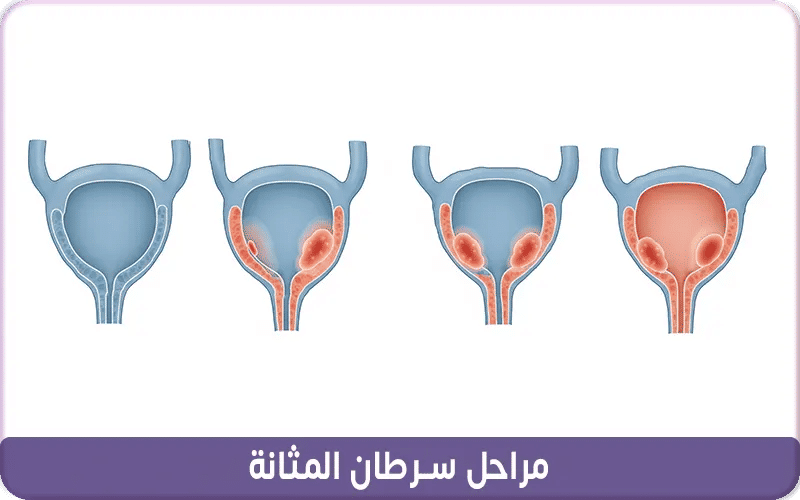 مراحل سرطان المثانة
