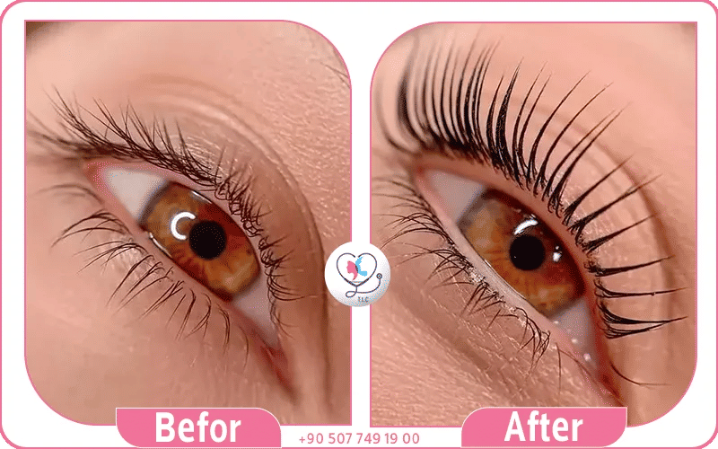 كيف تتم زراعة الرموش؟ كيف تتم زراعة الرموش؟