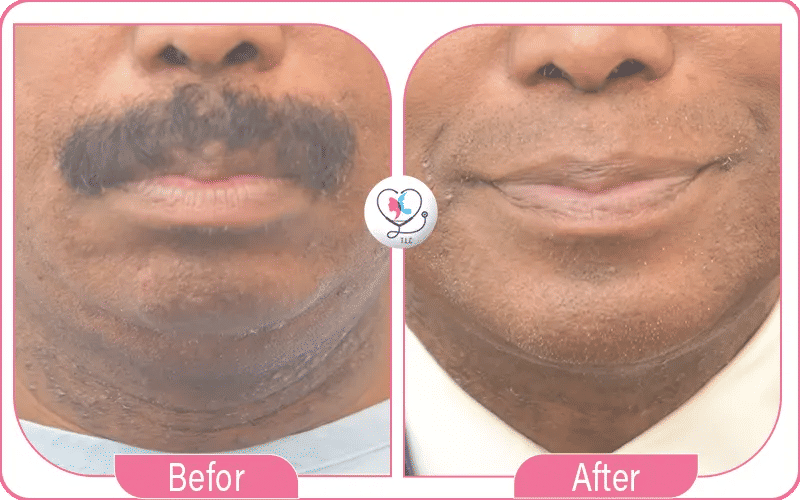 بعد ثلاثة أشهر من العملية